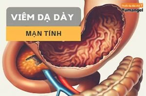 Cách điều trị viêm dạ dày mạn tính ở trẻ em và người lớn