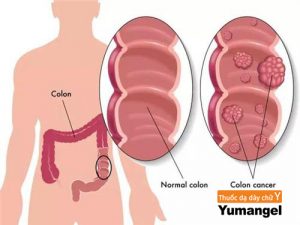 Có nên cắt Polyp dạ dày không