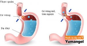 hình ảnh hở van dạ dày