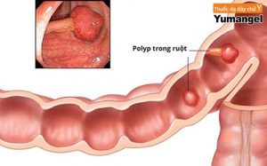 Bệnh polip trực tràng