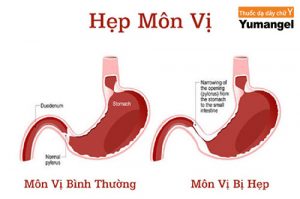 Cách chữa hẹp môn vị dạ dày