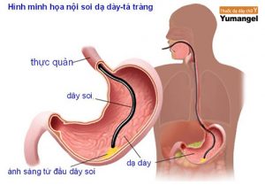 Nội soi dạ dày và đại tràng cùng lúc