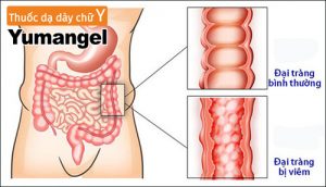 Tìm hiểu về viêm đại tràng