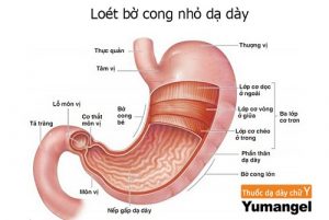 Viêm bờ cong dạ dày