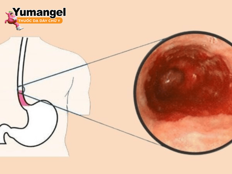 Hình ảnh và vị trí viêm loét thực quản