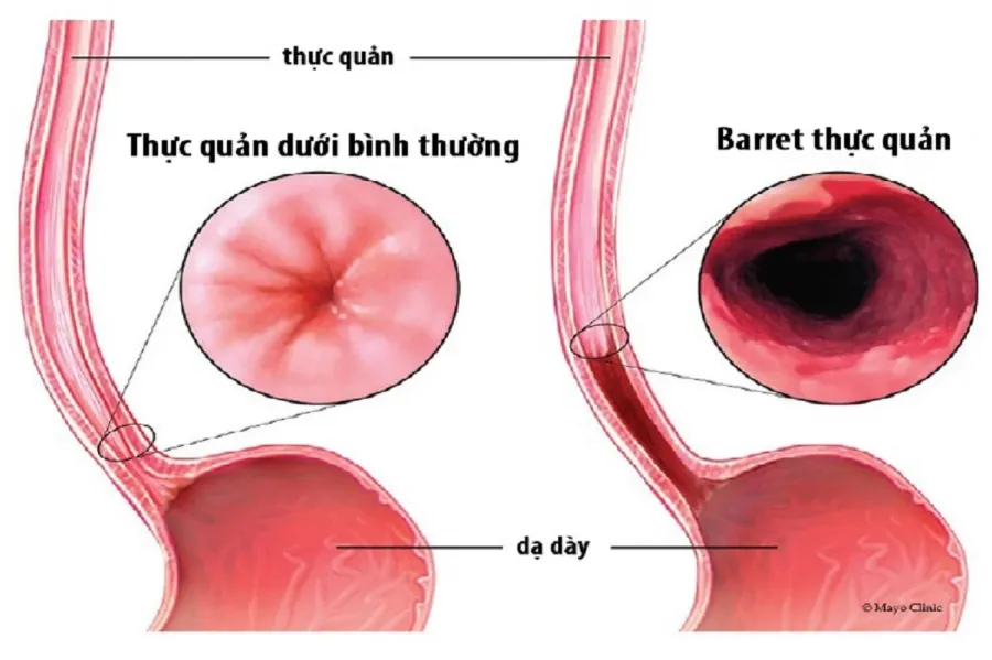 Barrett thực quản là gì?
