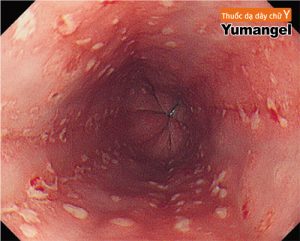 Bệnh nấm dạ dày có nguy hiểm không