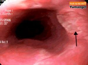 Viêm loét thực quản bệnh học