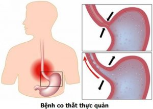 Bệnh co thắt thực quản là gì