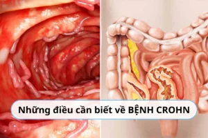 bệnh crohn
