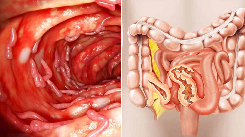 bệnh crohn