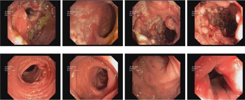 bệnh crohn