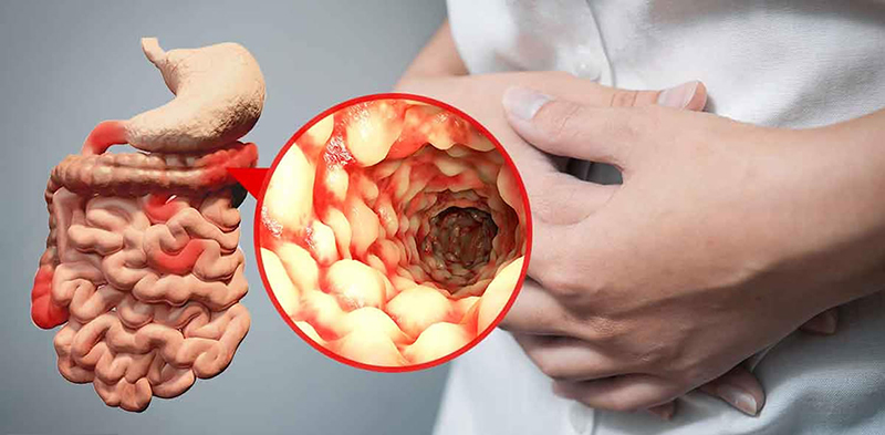 bệnh crohn