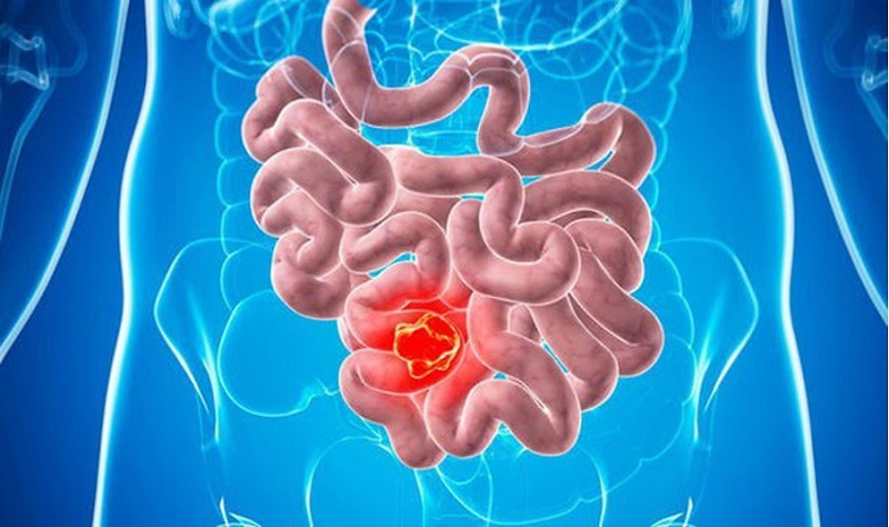 bệnh crohn