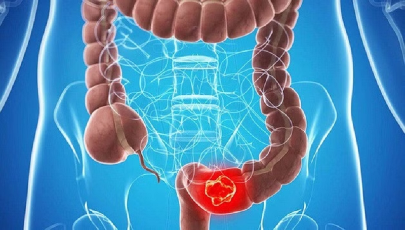bệnh crohn