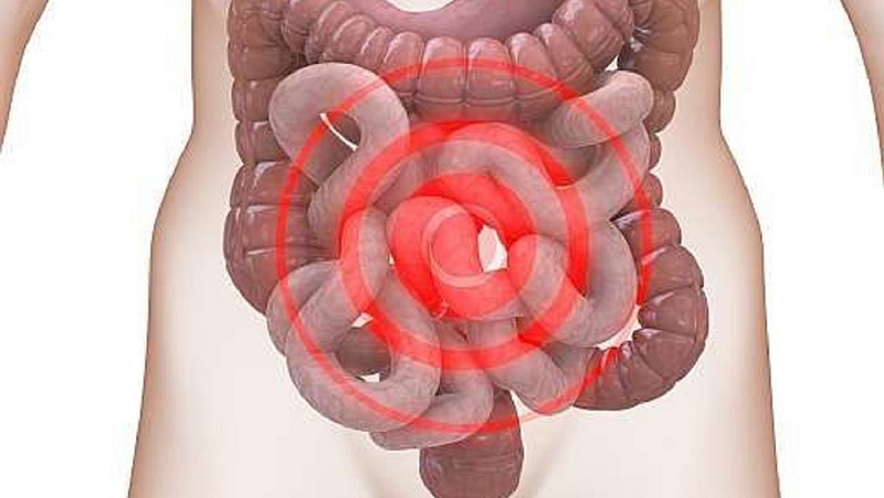 hội chứng ruột kích thích