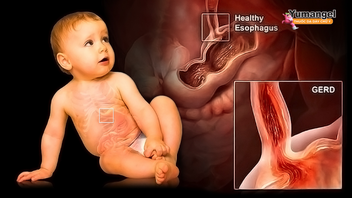 Trào ngược dạ dày thực quản ở trẻ em sơ sinh và dưới 2 tuổi khá phổ biến