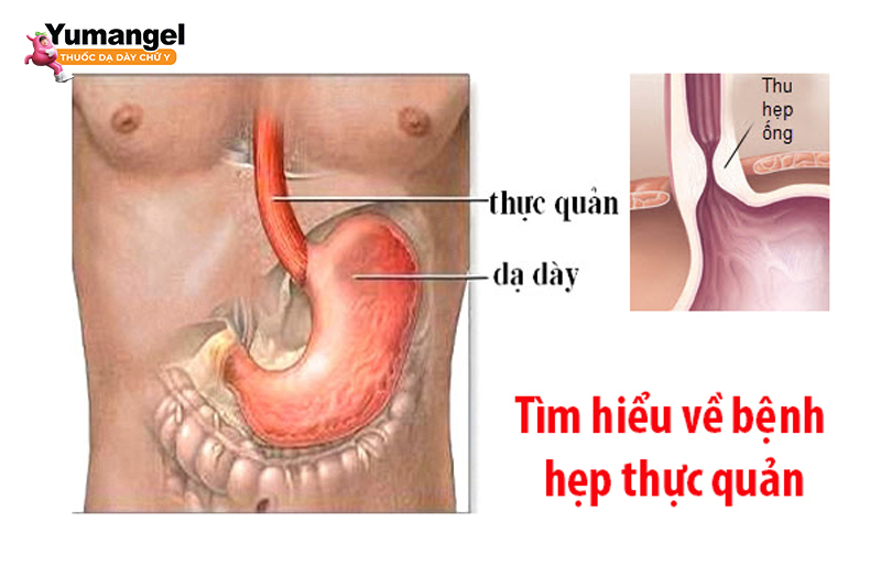 Hình ảnh thực quản bị thu hẹp. 