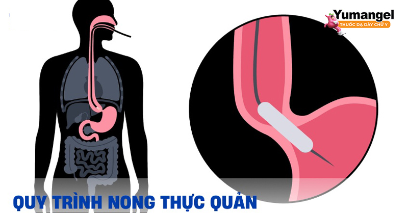 Phương pháp nong thực quản điều trị bệnh hẹp thực quản. 