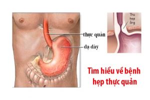 Bệnh hẹp thực quản có nguy hiểm không vâ