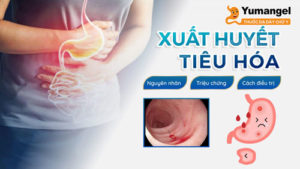 Nguyên nhân gây xuất huyết tiêu hóa trên do viêm loét dạ dày tá tràng, tăng áp lực tĩnh mạch cửa, chảy máu thực quản…