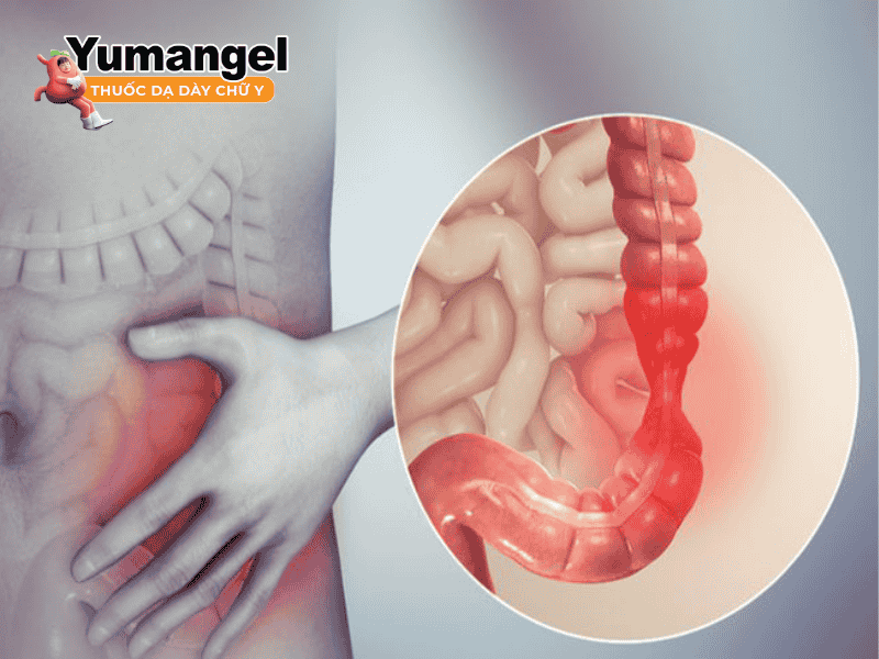 Hội chứng ruột ngắn hiện được phân thành 2 loại chính là bẩm sinh và mắc phải.