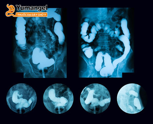 Chụp X-quang đại tràng cản quang chẩn đoán bệnh lao ruột.