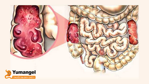 Lao ruột điều trị muộn có thể gây thủng ruột, viêm phúc mạc, nhiễm trùng huyết… 