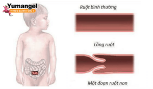 bệnh lồng ruột là gì và cách điều trị