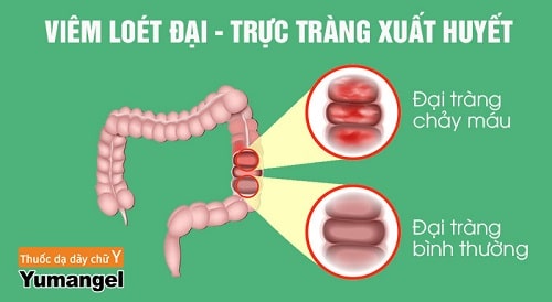 Bệnh viêm loét đại trực tràng là gì