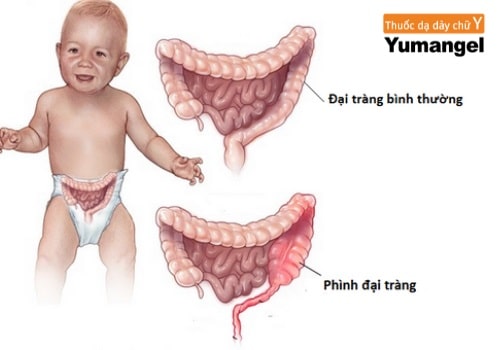 Bị phình đại tràng là gì