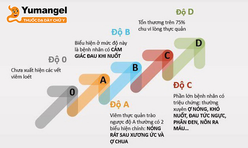 Các cấp độ của bệnh trào ngược dạ dày thực quản K21. 