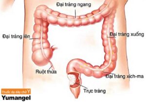 Cắt đại tràng sigma nội soi