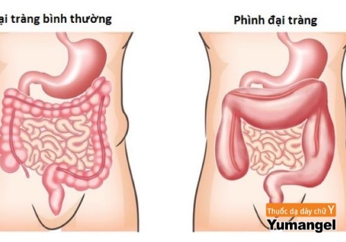 Chẩn đoán phình đại tràng ở người lớn