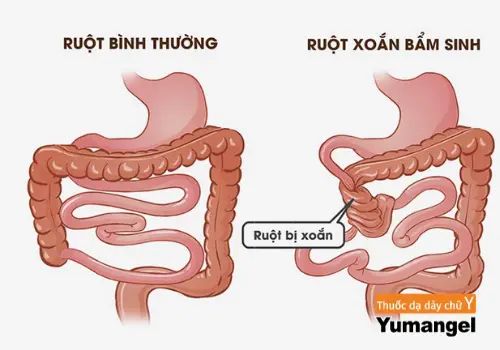 Không hiếm gặp bệnh xoắn ruột ở trẻ em.