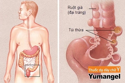 Đa túi thừa đại tràng là gì