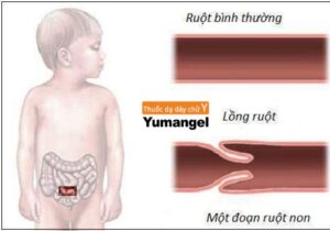 Dấu hiệu bị lồng ruột