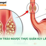 K21 là mã bệnh trào ngược dạ dày thực quản -  một bệnh lý tiêu hóa phổ biến.