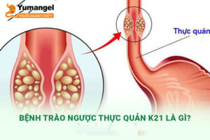 K21 là mã bệnh trào ngược dạ dày thực quản -  một bệnh lý tiêu hóa phổ biến.