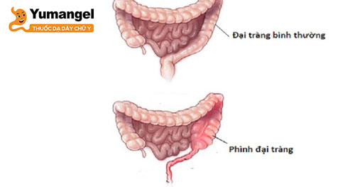 Bệnh phình đại tràng có 2 loại