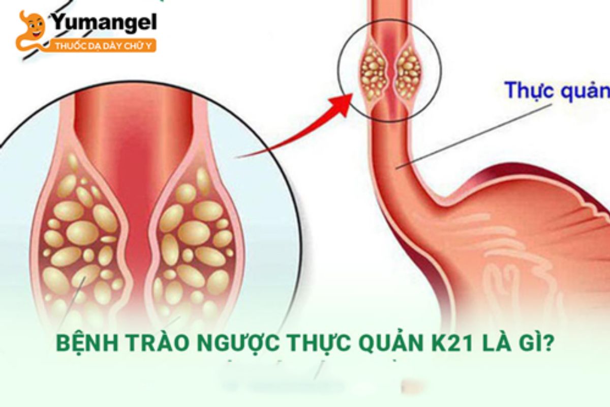 trao-nguoc-da-day-thuc-quan-1