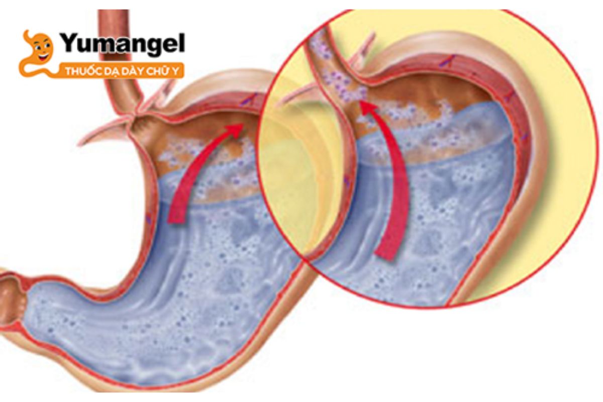 trao-nguoc-da-day-thuc-quan-3