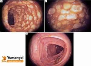 Hình ảnh viêm đại tràng màng giả mạc. 