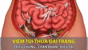 Viêm túi thừa đại tràng có nguy hiểm không