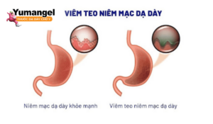 Cách điều trị viêm niêm mạc dạ dày