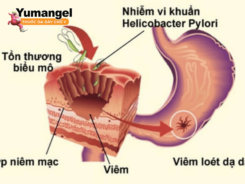 Nguyên nhân viêm niêm mạc dạ dày