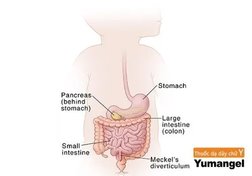 Hình ảnh túi thừa meckel giải phẫu