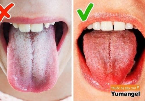 Trào ngược dạ dày gây viêm lưỡi là tình trạng không hiếm gặp Trào ngược dạ dày gây viêm lưỡi là tình trạng không hiếm gặp