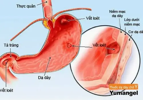 Viêm phù nề dạ dày là gì