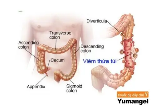 Viêm túi thừa meckel là gì